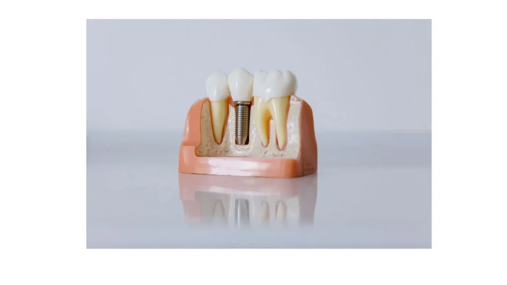 Dental Implants